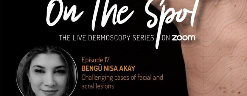 Dermlite Webinar: On the Spot EP 17